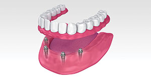 Full Arch Dental Implants Harrisonburg, VA